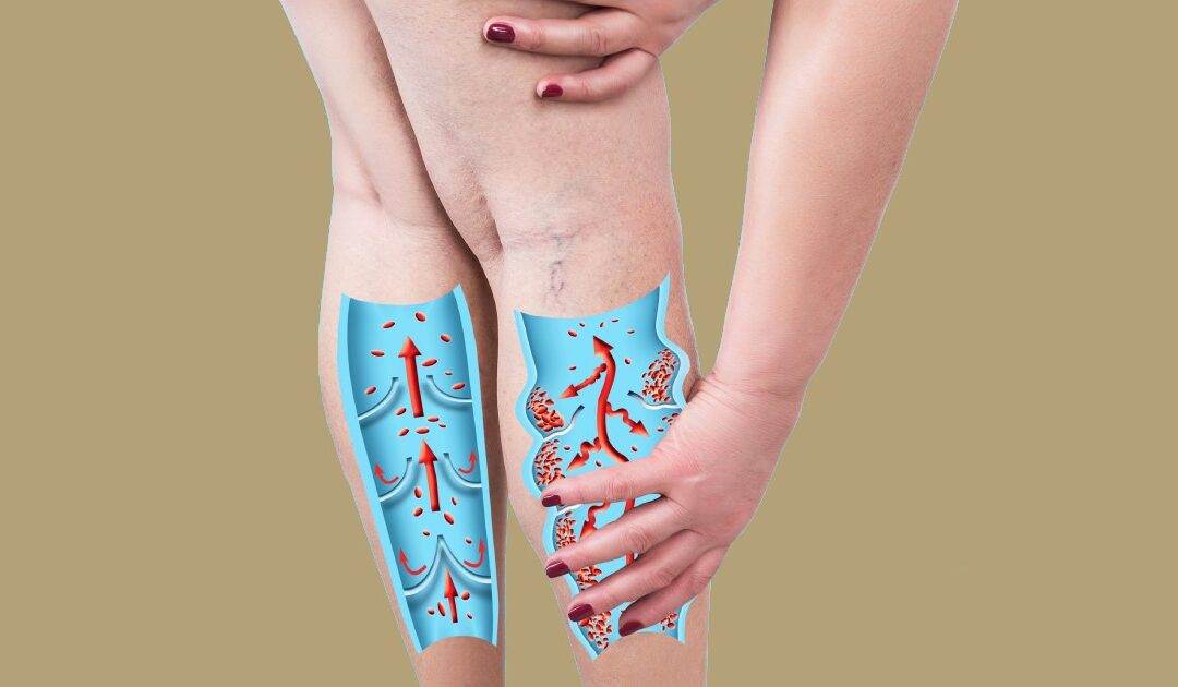 5 Myths about Vein Disease by A/Prof David Huber