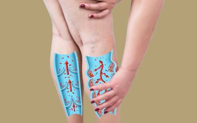 5 Myths about Vein Disease by A/Prof David Huber