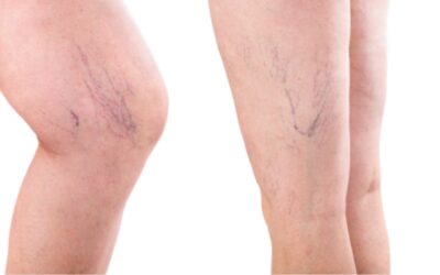 Sclerotherapy: your most asked questions answered