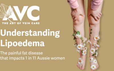 Understanding Lipoedema – The painful fat disease