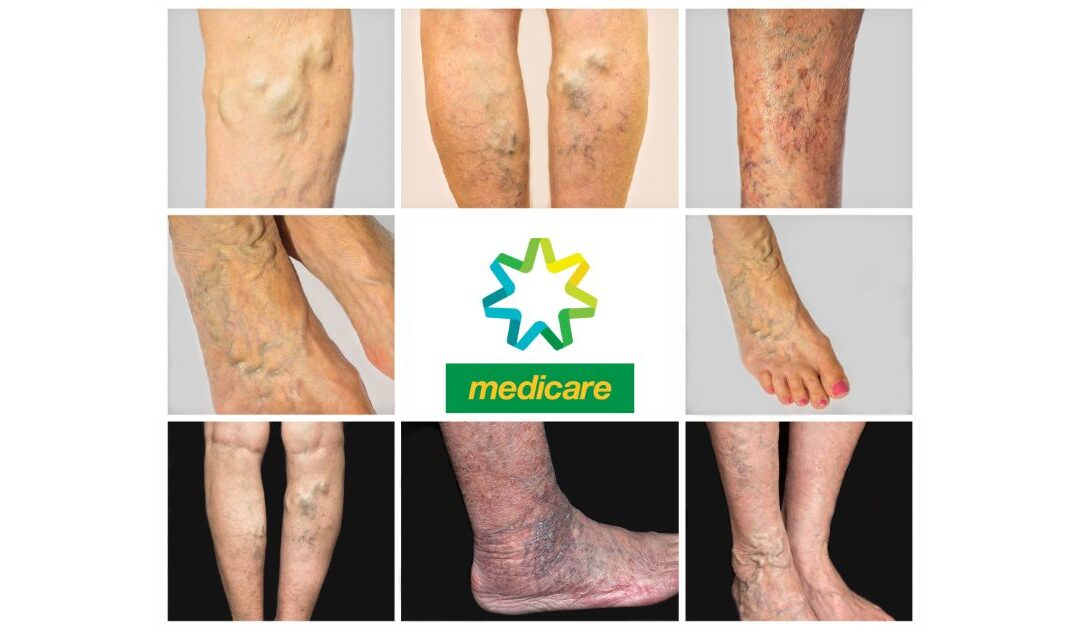 5 reasons that Medicare may partially rebate vein treatments