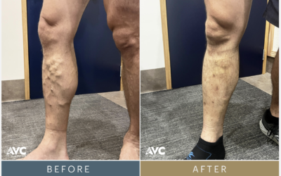 Vein Case Study – Before and After
